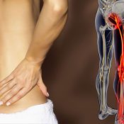 Sciatica – Basics