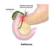 Gallbladder Stone